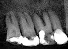 X-ray of teeth