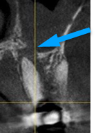 X-ray of teeth