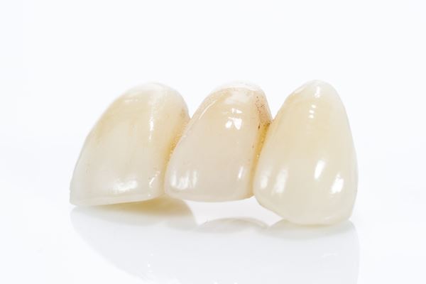 Photo of dental implants 