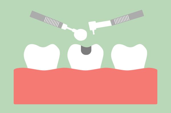 Tooth filling illustration