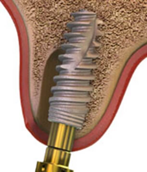 Dental Implant