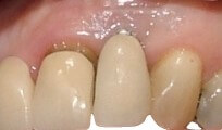 Dental Implant