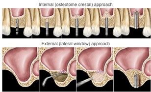 Dental Implant