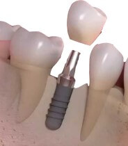 Dental Implant