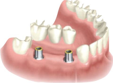 Multiple Dental Implants