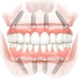 Dental Implant