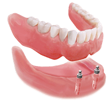 Dental Implant Over Dentures