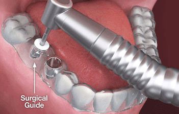 Dental Implant