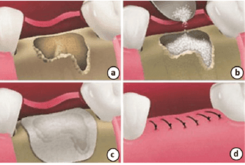 Dental Implant