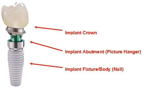 Dental Implant